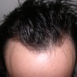 Hair Restoration Before & After Patient #3877
