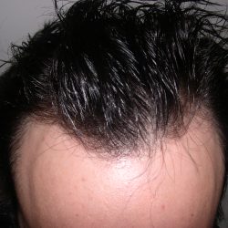 Hair Restoration Before & After Patient #3877