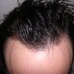 Hair Restoration Before & After Patient #2751