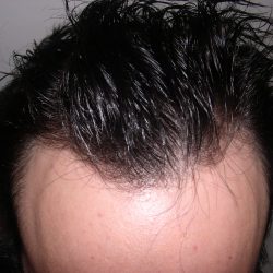 Hair Restoration Before & After Patient #2751