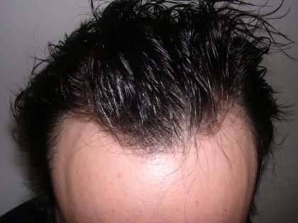 Hair Restoration Before & After Patient #2751
