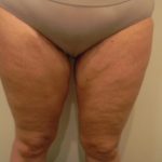 Thigh Lift Before & After Patient #3866