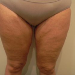 Thigh Lift Before & After Patient #3866