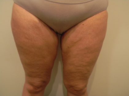 Thigh Lift Before & After Patient #3866