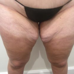 Thigh Lift Before & After Patient #3866