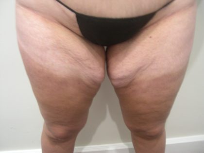 Thigh Lift Before & After Patient #3866