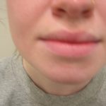 Lip Flip Before & After Patient #3804