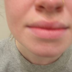Lip Flip Before & After Patient #3804