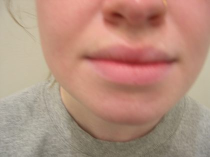 Lip Flip Before & After Patient #3804