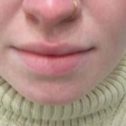 Lip Flip Before & After Patient #3804