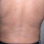 Liposuction Male Before & After Patient #3882