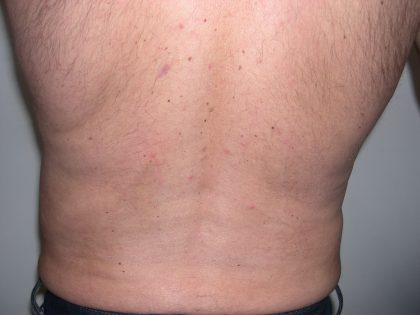 Liposuction Male Before & After Patient #3882