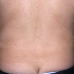 Liposuction Male Before & After Patient #3882