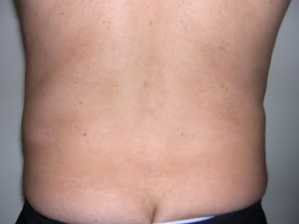 Liposuction Male Before & After Patient #3882