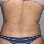 Liposuction Before & After Patient #4109