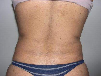 Liposuction Before & After Patient #4109