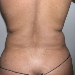 Liposuction Before & After Patient #4109