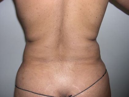Liposuction Before & After Patient #4109