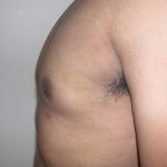 Gynecomastia Before & After Patient #3869