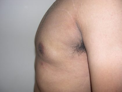 Gynecomastia Before & After Patient #3869