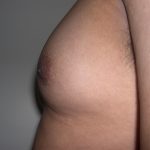 Gynecomastia Before & After Patient #3869