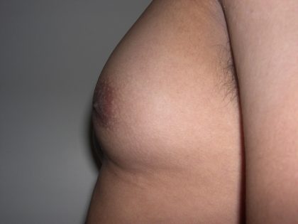Gynecomastia Before & After Patient #3869