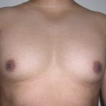 Gynecomastia Before & After Patient #3869