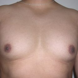 Gynecomastia Before & After Patient #3869