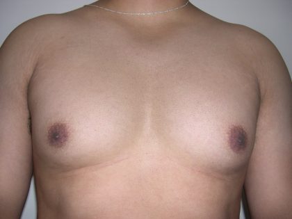 Gynecomastia Before & After Patient #3869