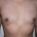 Gynecomastia Before & After Patient #3869