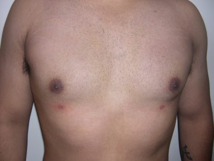 Gynecomastia Before & After Patient #3869