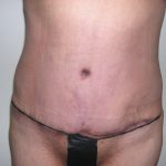 Mommy Makeover Before & After Patient #3839