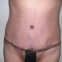 Mommy Makeover Before & After Patient #3839