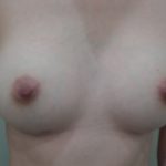 Breast Augmentation Before & After Patient #3672