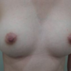 Breast Augmentation Before & After Patient #3672