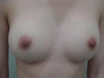 Breast Augmentation Before & After Patient #3672