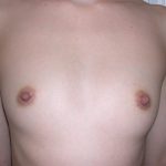 Breast Augmentation Before & After Patient #3672