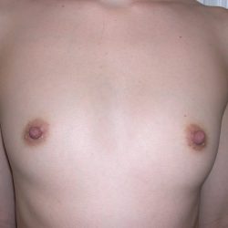 Breast Augmentation Before & After Patient #3672