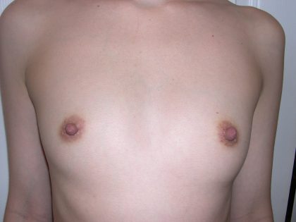Breast Augmentation Before & After Patient #3672