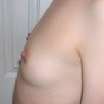 Breast Augmentation Before & After Patient #3672