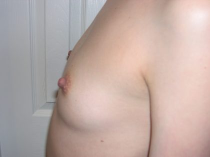 Breast Augmentation Before & After Patient #3672