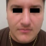 Rhinoplasty Male Before & After Patient #3899