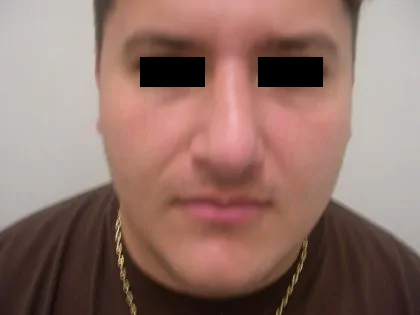 Rhinoplasty Male Before & After Patient #3899