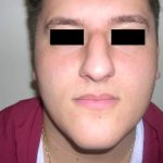Rhinoplasty Male Before & After Patient #3899