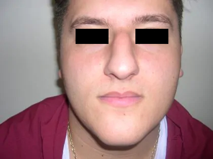 Rhinoplasty Male Before & After Patient #3899
