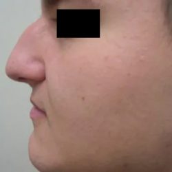 Rhinoplasty Male Before & After Patient #3899