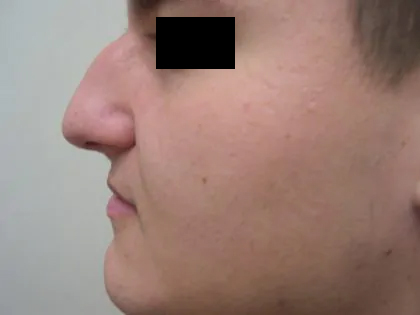Rhinoplasty Male Before & After Patient #3899