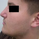 Rhinoplasty Male Before & After Patient #3899