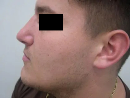 Rhinoplasty Male Before & After Patient #3899