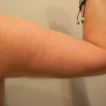 Arm Lift Before & After Patient #3668